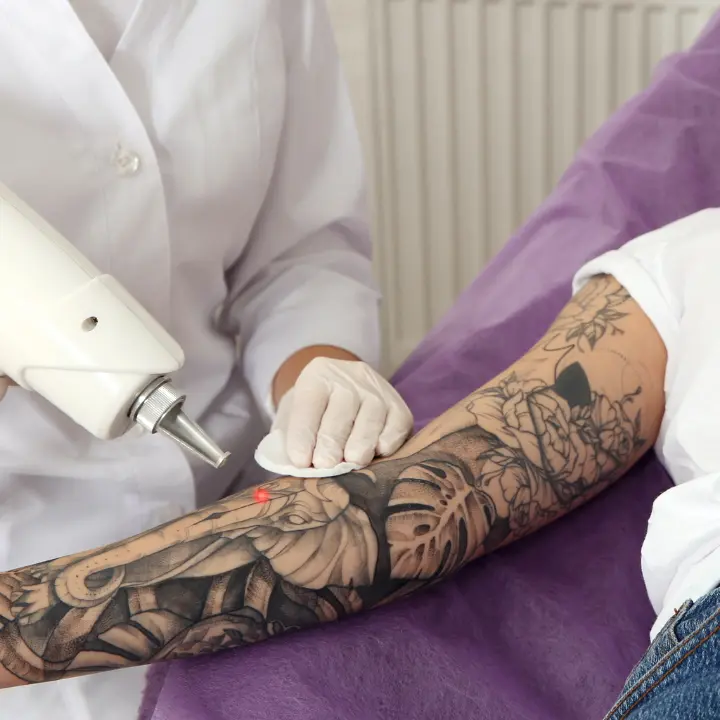 eliminar tatuaje con láser